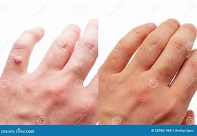 Image result for Ring Wart Treatment