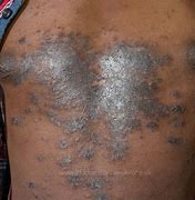 Image result for Kaposi Sarcoma Black Skin