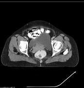 Image result for Cervical Cancer CT Scan