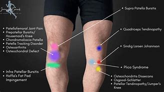 Image result for Sharp Knee Pain