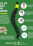Image result for Spinal Cord Contusion