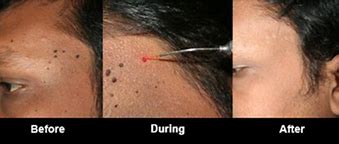 Image result for Wart Remover On Mole Before and After