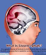 Image result for Lissencephaly Developmental Chart