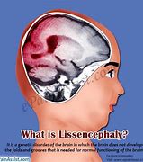 Image result for Oldest Person with Lissencephaly