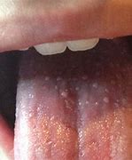 Image result for Hard Spot On Back of Tongue