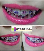 Image result for Teal and Hot Pink Braces