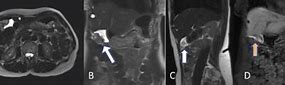 Image result for MRI T2 Axial Abdomen
