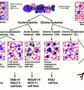 Image result for Types of Leukemia in Adults