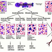 Image result for Leukemia Stage 1