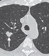 Image result for Multiple Lung Nodules