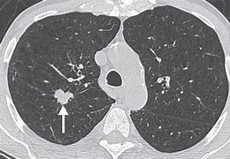 Image result for Spiculated Lung Nodule