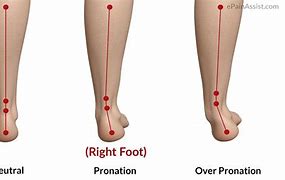 Image result for Ankle Pronation