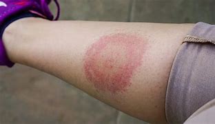 Image result for Round Red Rash On Leg