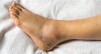 Image result for Left Ankle Swelling