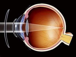 Image result for Eye Corrective Lens