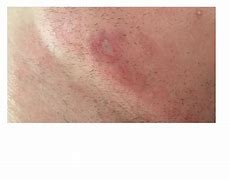 Image result for Cut Scab
