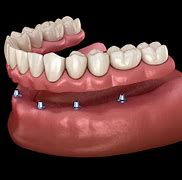 Image result for Lower Denture Implants