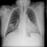 Image result for Solitary Pulmonary Nodule Radiology Assistant