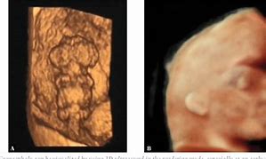Image result for Fetal Acrania