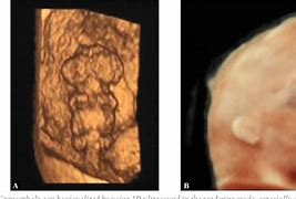 Image result for Exancephaly