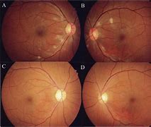 Image result for White Patches On Retina
