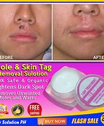 Image result for Wart and Mole Vanish