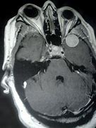 Image result for Brain Tumor Behind Eye