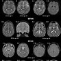 Image result for CT Scan of OCD Brain