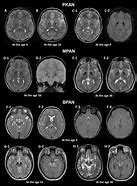 Image result for Brain Uncaged