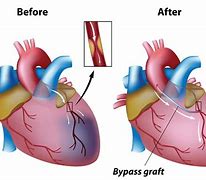 Image result for Artery Bypass Surgery