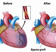 Image result for Coronary Artery Bypass Graft Model