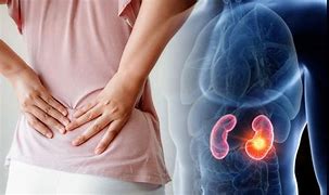 Image result for Kidney Stones Lower Back Pain