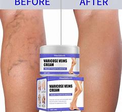 Image result for Varicose Cream for Legs