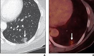 Image result for Ground Glass Nodule in Lung