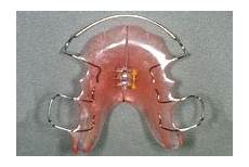apparecchio mobile apparecchio dentale ortodonzia dott marco dormi apparecchio mobile apparecchio dentale ortodonzia dott marco dormi