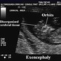 Image result for Anencephaly Ultrasound