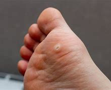 Image result for Infected Wart Bottom of Foot