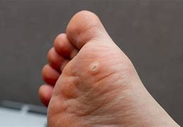Image result for Plantar Wart Hole in Foot