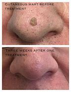 Image result for Wart Before and After Cryotherapy