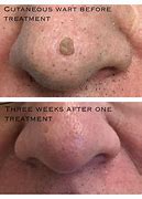 Image result for Skin Care After Wart Removal
