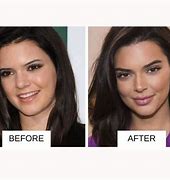 Image result for Kendall Vertes Before and After Lip Filler