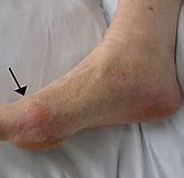 Image result for Penyakit Gout