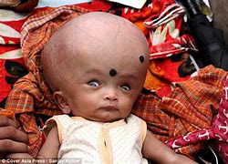 Image result for Indian Baby with Hydrocephalus