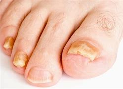 Image result for Embromar Los Pies