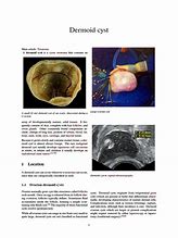 Image result for Dermoid Cyst Brain