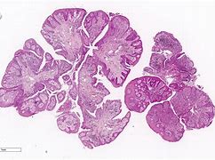 Image result for Conjunctival Papilloma Pathology