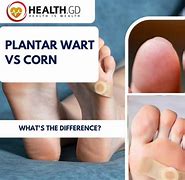 Image result for Plantar Wart V Corn