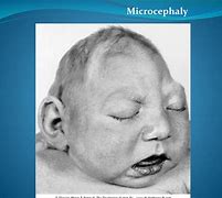 Image result for Meroencephaly