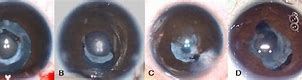 Image result for Posterior Synechiae Iris