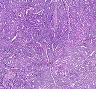 Image result for Endometrioid Tumor